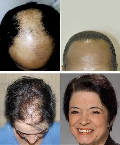 hair transplant doctor San Francisco, CA - Parsa Mohebi Hair Restoration -  Parsa Mohebi Hair Restoration